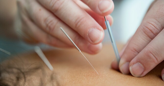 Dry Needling vs. Acupuncture in Evanston: What’s the Difference — and Why It Matters image